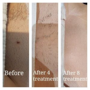 laser haarentfernung münchen preise