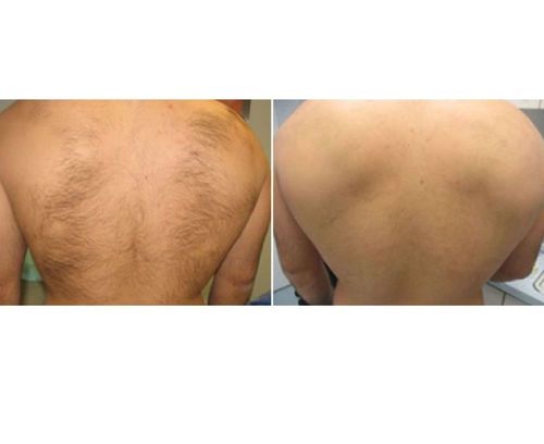 preise laser haarentfernung münchen